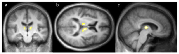 Coronal (A), axial (B) and sagittal (C) sections showing the significant CBF decreases on tozadenant 60 mg twice daily.